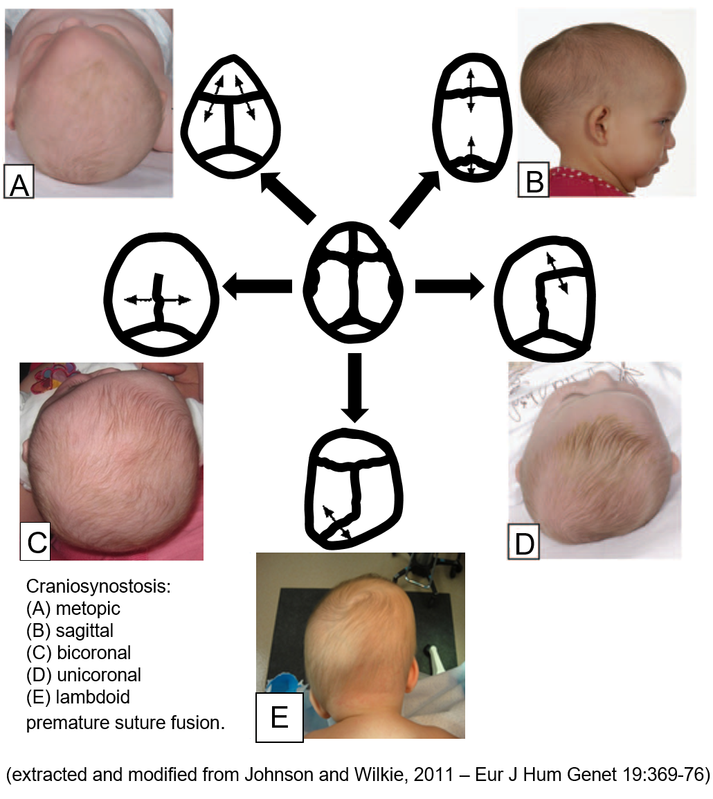 craniosynostosis